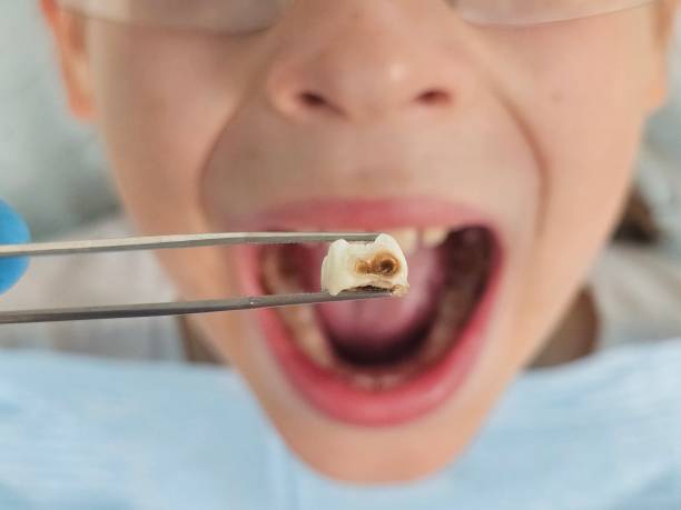 Best Emergency Treatment for Toothache in Junction City, OR